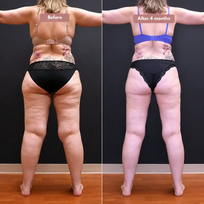 3D legging - say goodbye to lipedema pain and swelling naturally