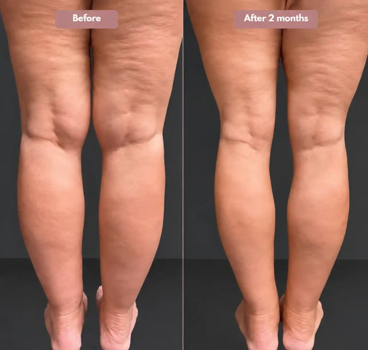 3D legging - say goodbye to lipedema pain and swelling naturally