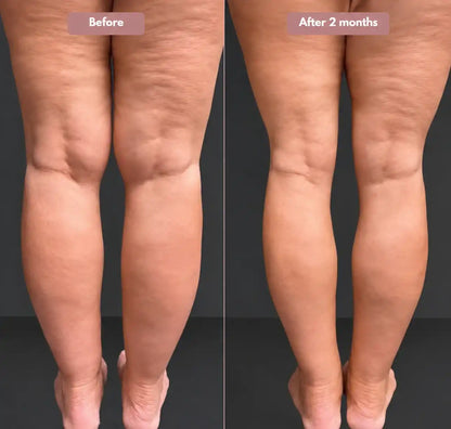 3D legging - say goodbye to lipedema pain and swelling naturally