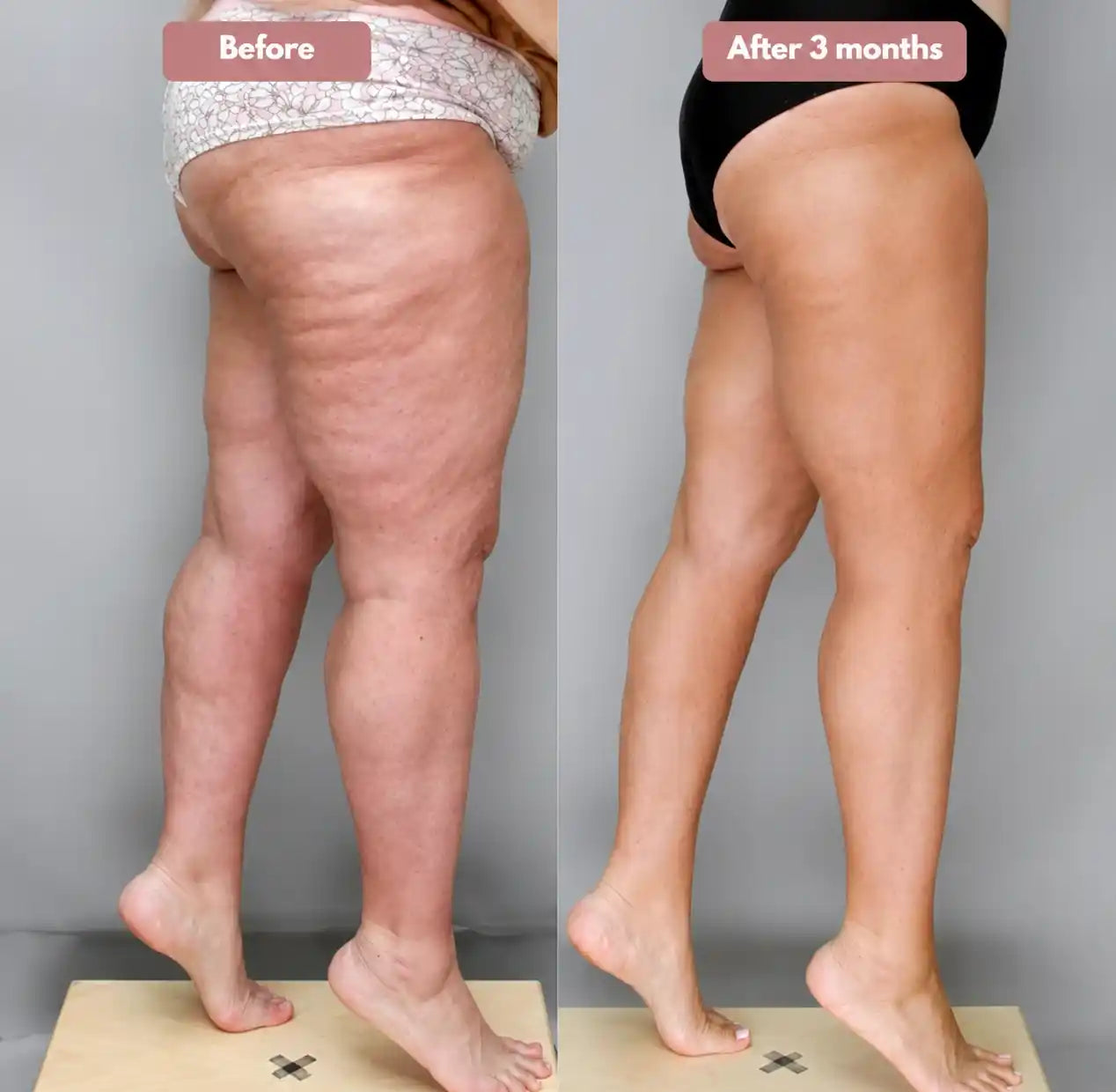 3D legging - say goodbye to lipedema pain and swelling naturally